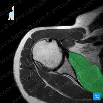 Subscapularis muscle (Musculus subscapularis); Image: 