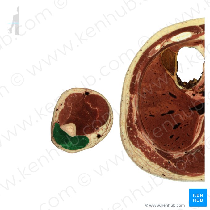 Músculo tríceps braquial (Musculus triceps brachii); Imagem: National Library of Medicine