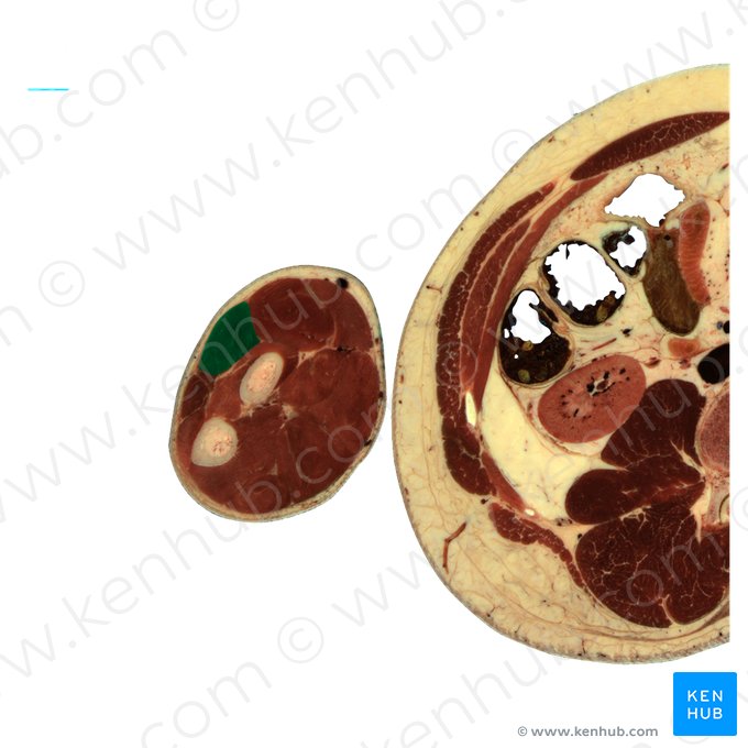 Musculus extensor digitorum (Fingerstrecker); Bild: National Library of Medicine