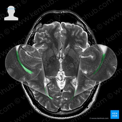 Cornu occipitale ventriculi lateralis (Hinterhorn des Seitenventrikels); Bild: 