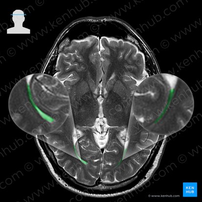 Asta occipital del ventrículo lateral (Cornu occipitale ventriculi lateralis); Imagen: 