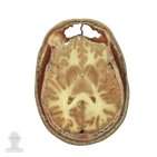 Thalamus Level