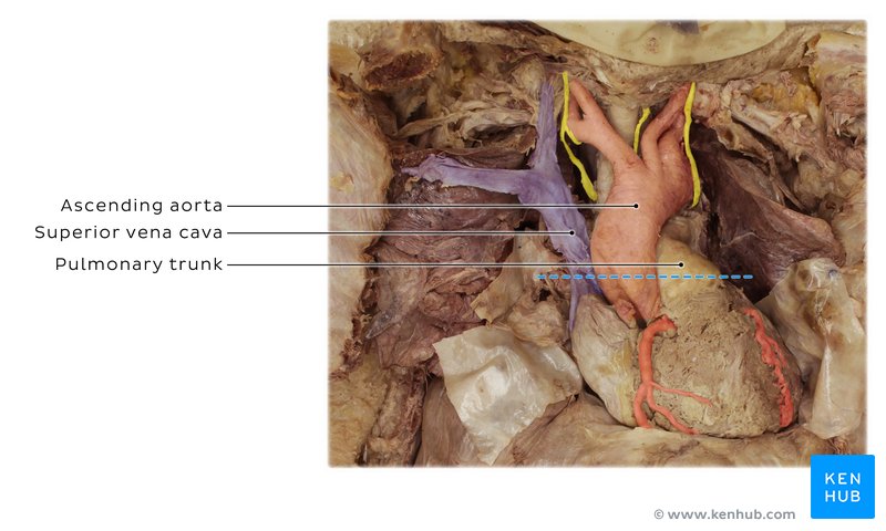 Photo of cadaver heart showing the section of CT indicated (blue-dashed line).