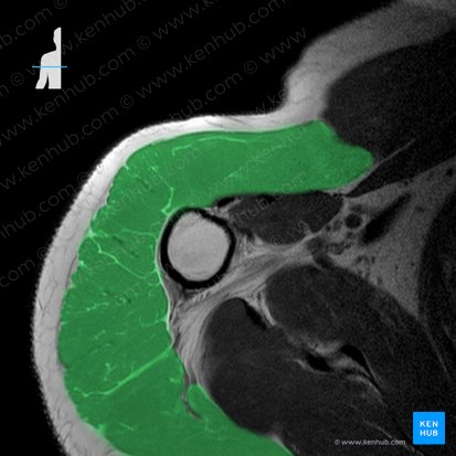 Músculo deltoide (Musculus deltoideus); Imagem: 