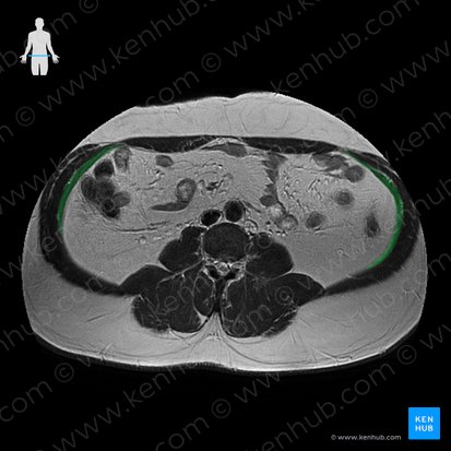 Musculus transversus abdominis (Querer Bauchmuskel); Bild: 