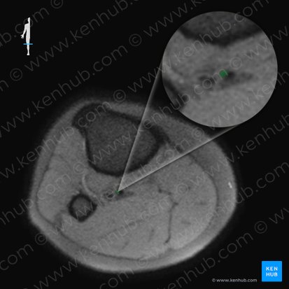 Anterior tibial vein (Vena tibialis anterior); Image: 