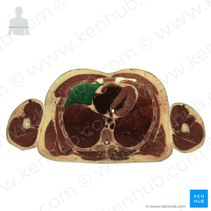 Middle lobe of right lung (Lobus medius pulmonis dextri); Image: National Library of Medicine