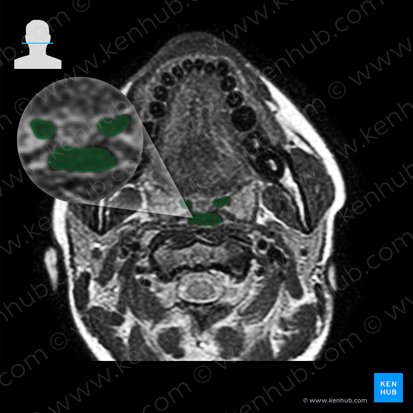 Oropharynx (Pars oralis pharyngis); Image: 