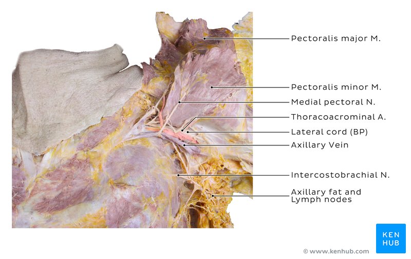 Axillary region with pectoralis muscle reflected - anterior view