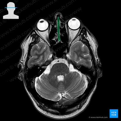 Nasal septum (Septum nasi); Image: 