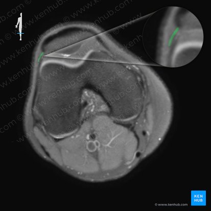 Retinaculum patellae laterale (Äußerer Kniescheibenzügel); Bild: 