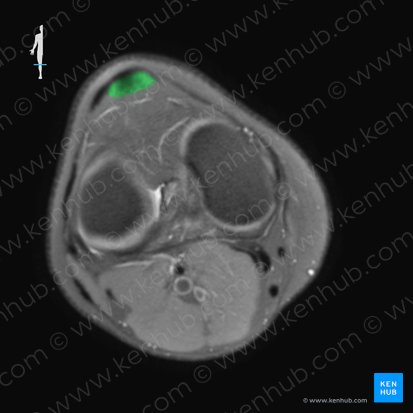 Patella; Image: 