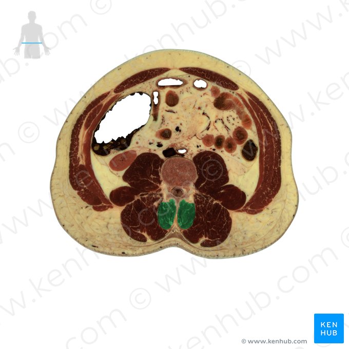 Musculus multifidus (Vielgefiederter Muskel); Bild: National Library of Medicine