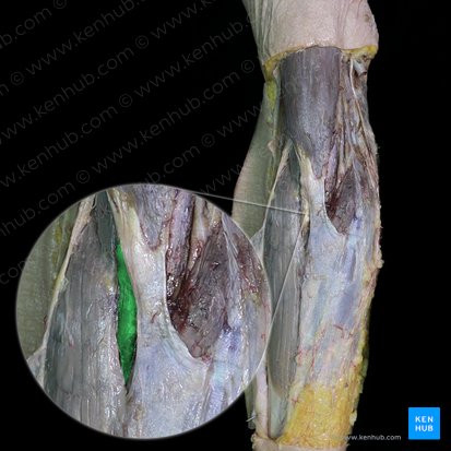 Distal tendon of biceps brachii muscle (Tendo distalis musculi bicipitis brachii); Image: 