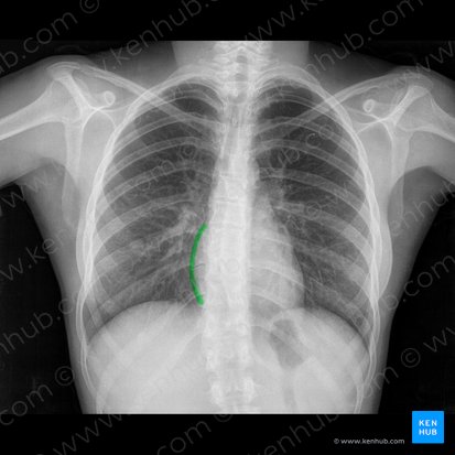 Border of right atrium (Margo atrii dextri); Image: 