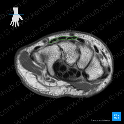 Bainha tendínea dos músculos extensor dos dedos e extensor do indicador (Vagina tendinum musculorum digitorum et extensoris indicis); Imagem: 