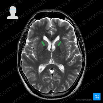 Crus anterius capsulae internae (Vorderer Schenkel der inneren Kapsel); Bild: 