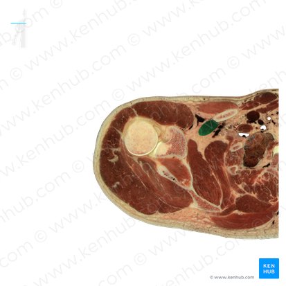 Músculo subclávio (Musculus subclavius); Imagem: National Library of Medicine