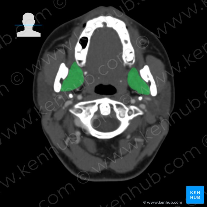 Músculo pterigóideo medial (Musculus pterygoideus medialis); Imagem: 