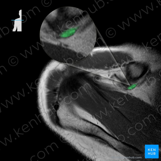 Ligamento conoide (Ligamentum conoideum); Imagen: 