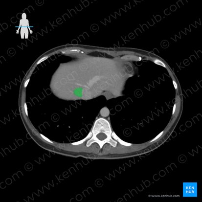 Right hepatic vein (Vena hepatica dextra); Image: 