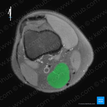 Semimembranosus muscle (Musculus semimembranosus); Image: 