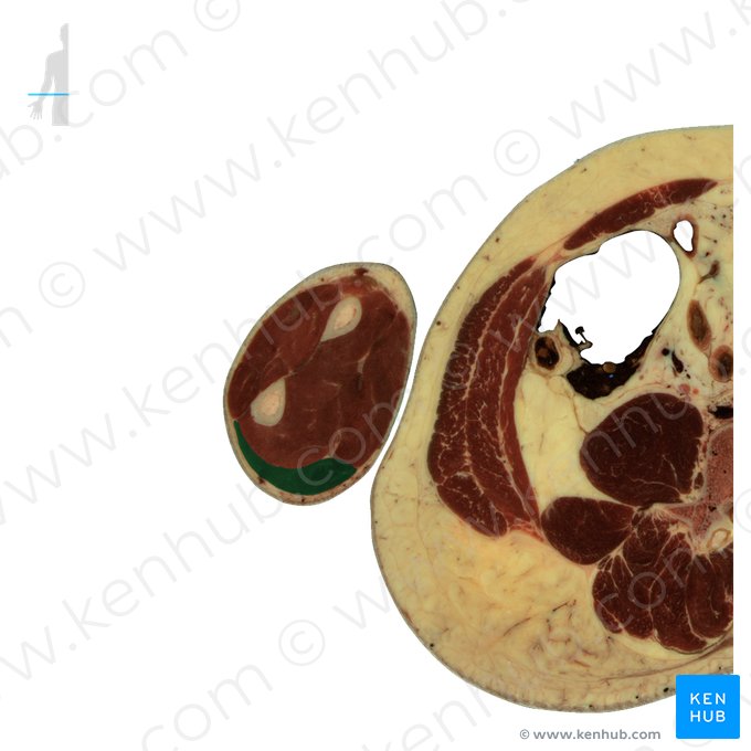 Músculo flexor ulnar do carpo (Musculus flexor carpi ulnaris); Imagem: National Library of Medicine