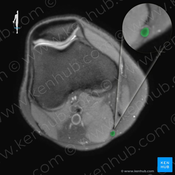 Tendon of semitendinosus muscle (Tendo musculi semitendinosi); Image: 