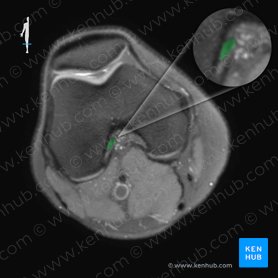 Anterior cruciate ligament (Ligamentum cruciatum anterius); Image: 