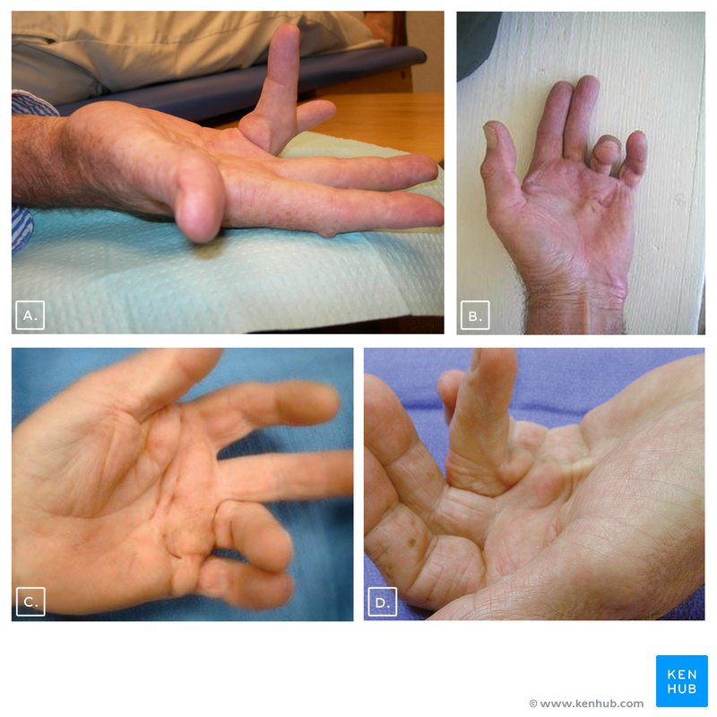 Dupuytren's contracture