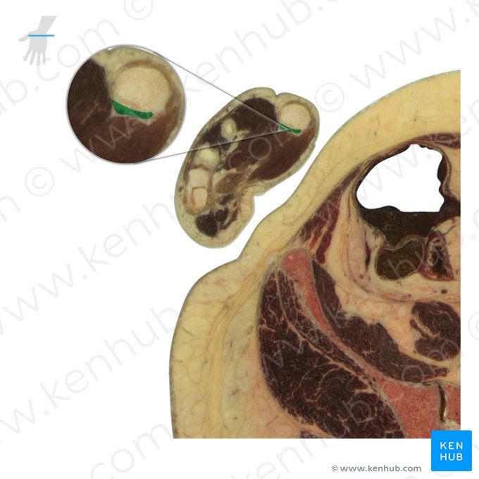 Tendão do músculo flexor longo do polegar (Tendo musculi flexoris pollicis longi); Imagem: National Library of Medicine