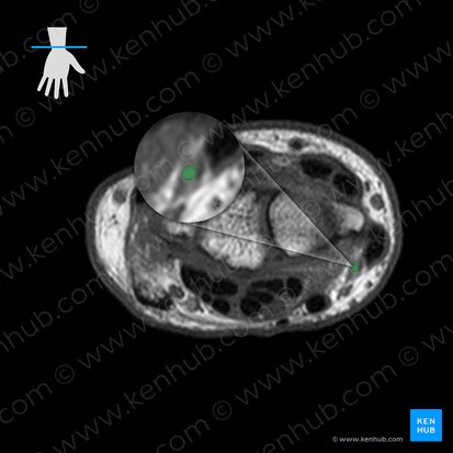 Radial artery (Arteria radialis); Image: 