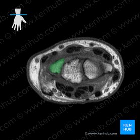 Triquetrum bone (Os triquetrum); Image: 