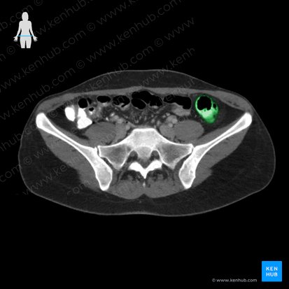 Descending colon (Colon descendens); Image: 