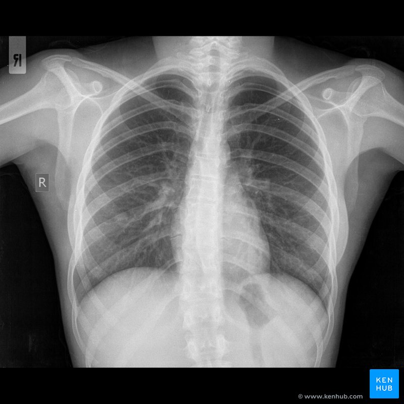 Typical magnetic resonance imaging scan showing the coracohumeral