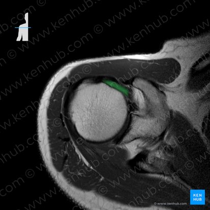 Tendón de la cabeza larga del músculo bíceps braquial (Tendo capitis longi musculi bicipitis brachii); Imagen: 