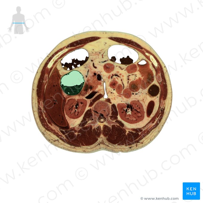 Cólon ascendente (Colon ascendens); Imagem: National Library of Medicine