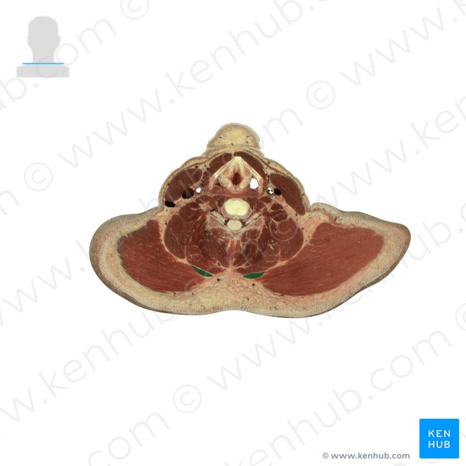 Rhomboid minor muscle (Musculus rhomboideus minor); Image: National Library of Medicine