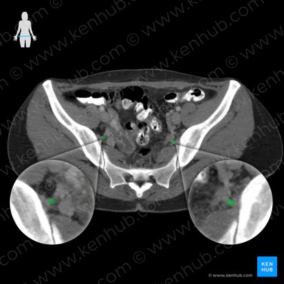 Arteria glutea superior (Obere Gesäßarterie); Bild: 