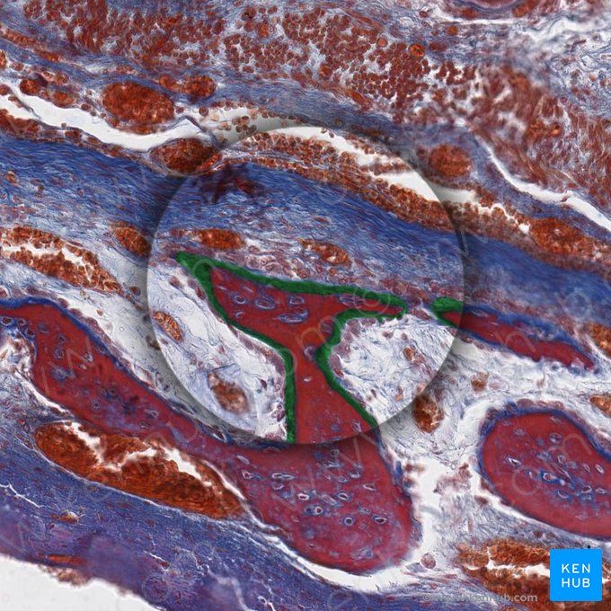 Osteoide (Osteoideum); Imagen: 