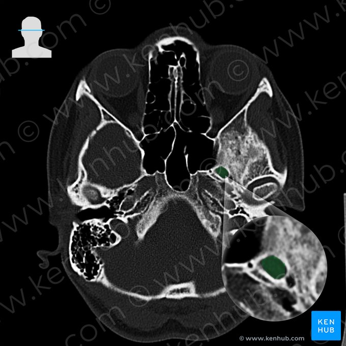 Foramen oval del hueso esfenoides (Foramen ovale); Imagen: 