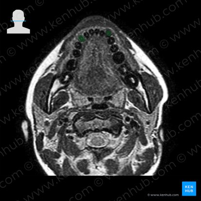 Canine tooth (Dens caninus); Image: 