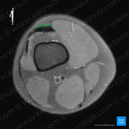 Tendão do músculo reto femoral (Tendo musculi recti femoris); Imagem: 