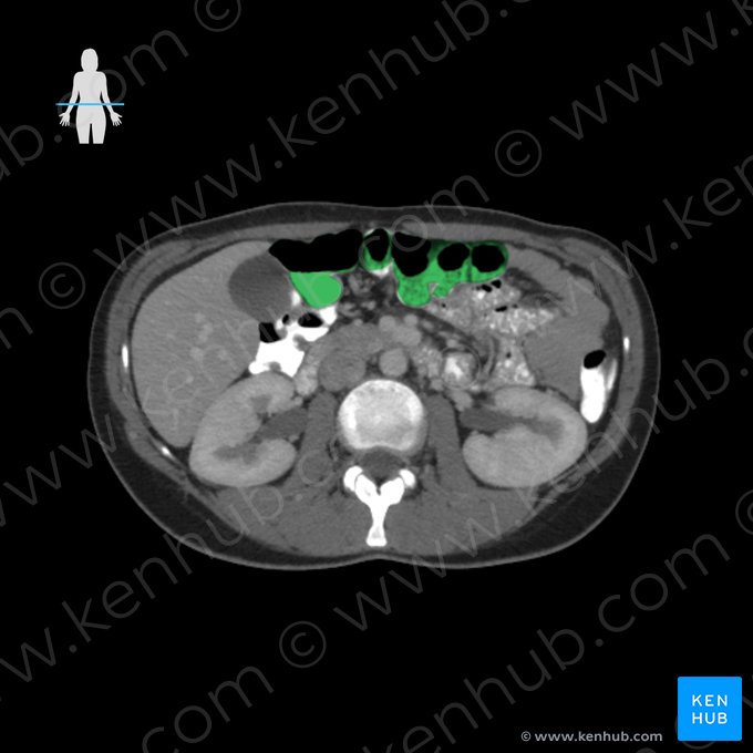 Colon transverso (Colon transversum); Imagen: 