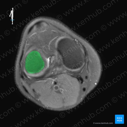 Lateral condyle of femur (Condylus lateralis ossis femoris); Image: 