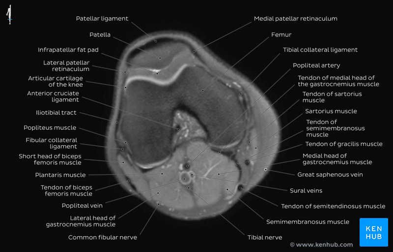 Knee MRI PD overview - Femoral condyles level