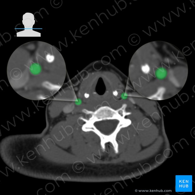 Common carotid artery (Arteria carotis communis); Image: 