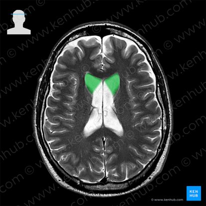 Cornu frontale ventriculi lateralis (Vorderhorn des Seitenventrikels); Bild: 
