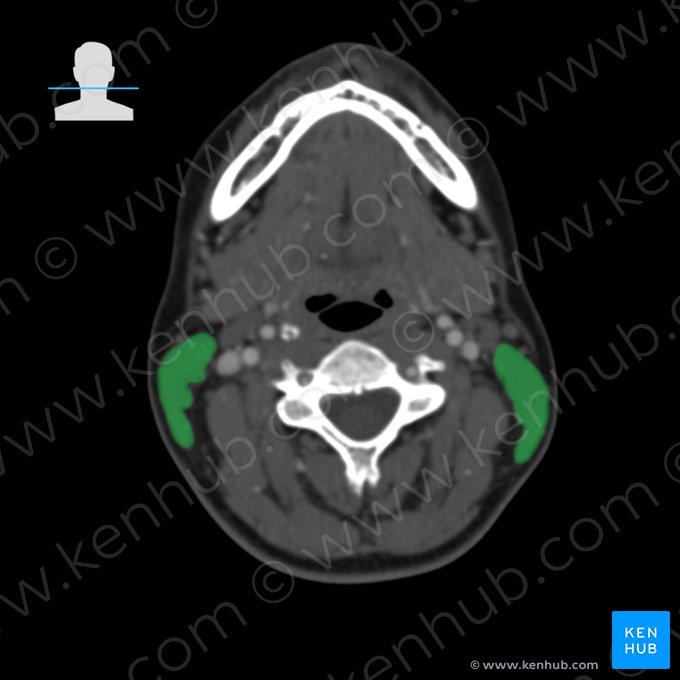 Musculus sternocleidomastoideus (Kopfwender); Bild: 