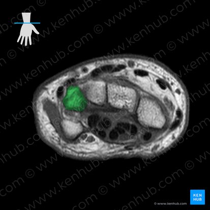 Triquetrum bone (Os triquetrum); Image: 